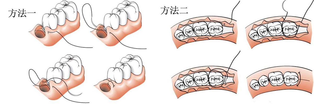 牙周治療手術縫合線縫合方法示意圖.jpg